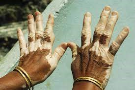 Tips of Treating Vitiligo in Summer Holidays